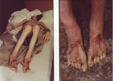 David Nebreda, “Les blessures aux pieds sont déjà refermées”